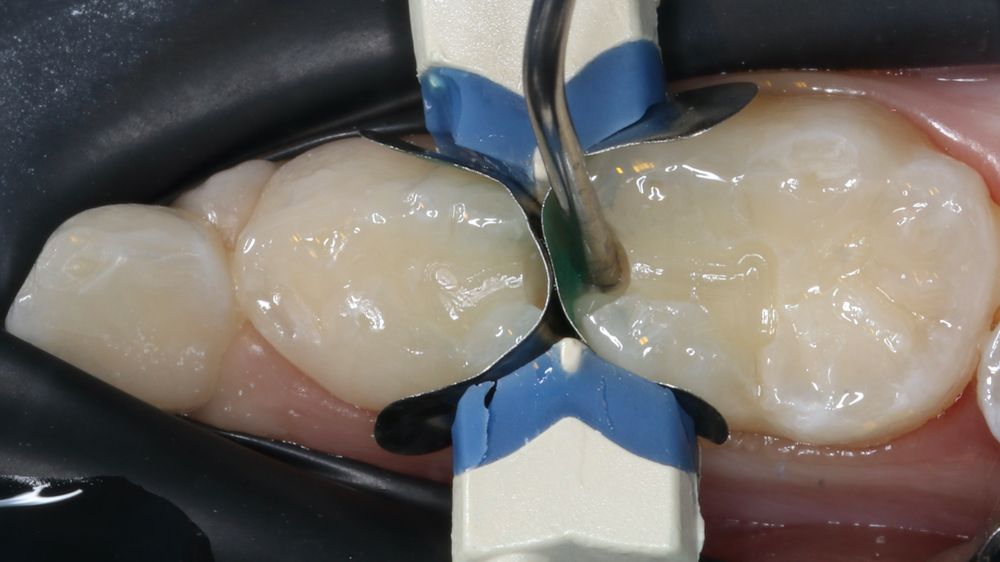 How To Use Composites That Stand the Test of Time for Pediatric Patients